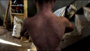 САМЫЕ РЕДКИЕ И МУЧИТЕЛЬНЫЕ БОЛЕЗНИ