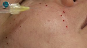 Биоревитализация лица Подробное видео