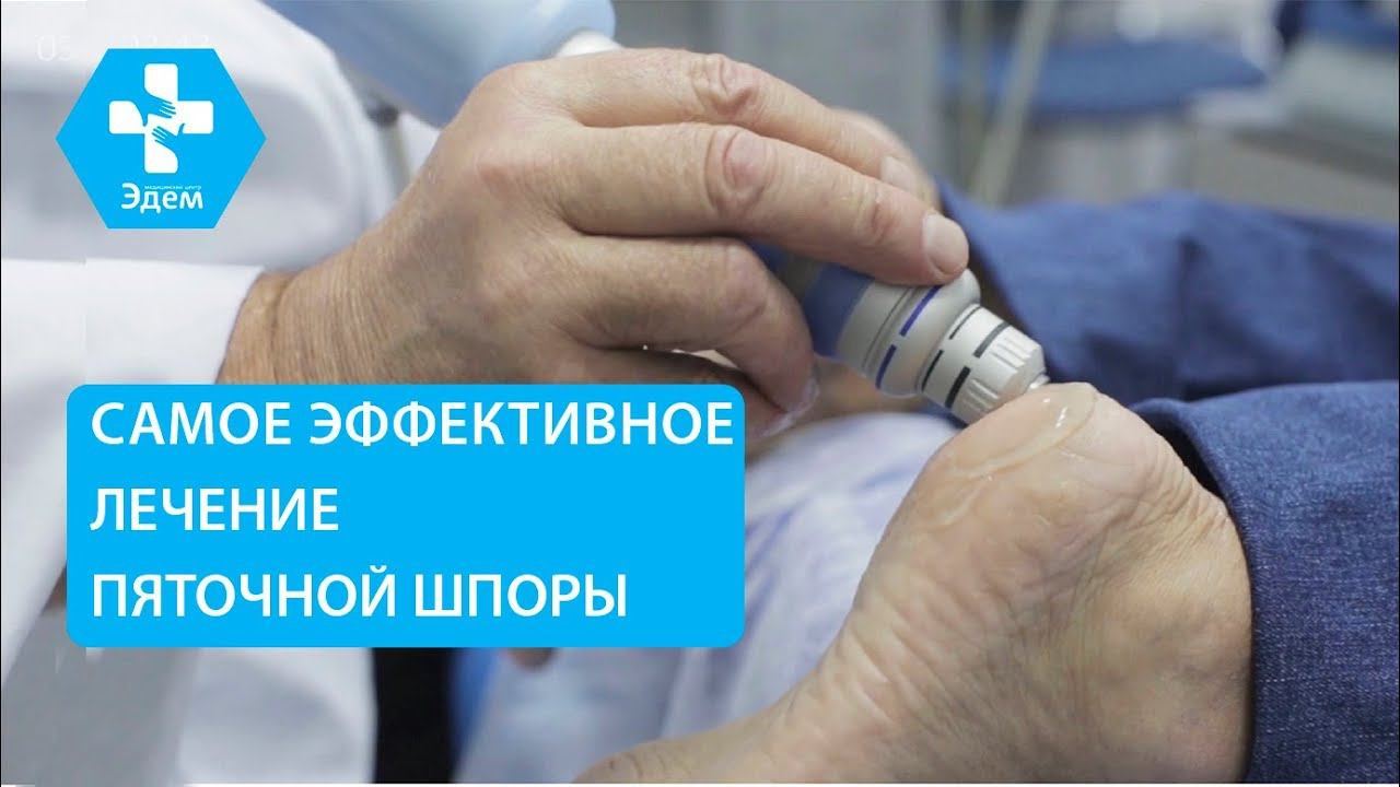 Как лечить пяточную шпору методом ударно волновой терапии. Пяточная шпора как лечить. ЭДЕМ. 12+