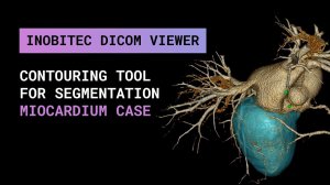 Инструмент оконтуривания для сегментации в Inobitec DICOM Viewer Pro на примере миокарда