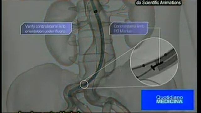 Aneurisma aorta addominale. Endoprotesi con chirurgia ibrida mininvasiva