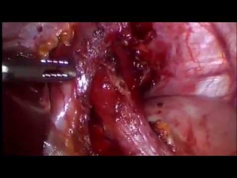 heller myotomy (ахалазия кардии миотомия) смотреть онлайн
