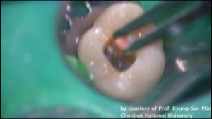 Any-Seal силер для пломбирования каналов.mp4