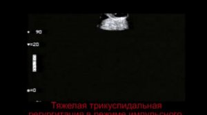 5. Аномалия Эбштейна у плода, часть 2 (Ebstein's anomaly in fetus)