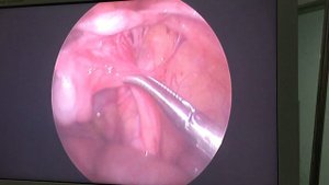 Abdominal Kriptorxizm . Абдоминальная форма крипторхизм.