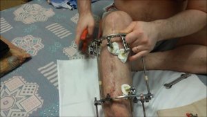 Снятие аппарата Илизарова Часть 1