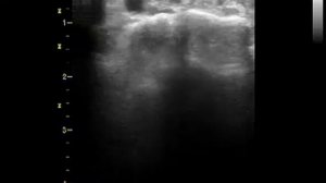 Теносиновит разгибателей кисти