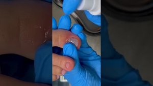 Зачем прокалывать ноготь при гематоме? А Вы смотрели полное видео? Ссылка в описании! #shorts
