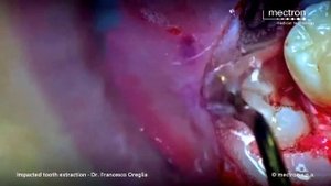 Удаление ретинированного зуба