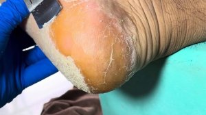 Thick cracked foot calluses, very relaxing【Xue Yidao】