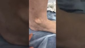 Осмотр флеболога Сардара Алиханова. Флеболог. Москва.