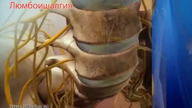 Люмбоишиалгия смотреть онлайн