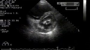 Митральный стеноз. Эхокардиография © Mitral stenosis. Echocardiographic diagnosis