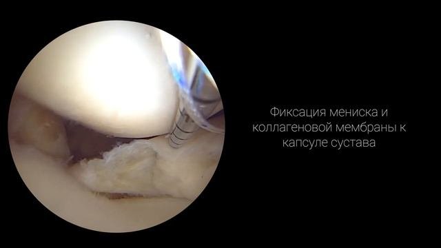 Пластика ПКС и шов внутреннего мениска с использованием коллагеновой мембраны