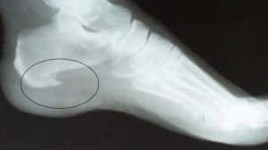 Пяточная шпора, лечение в домашних условиях народными средствами быстро и не больно