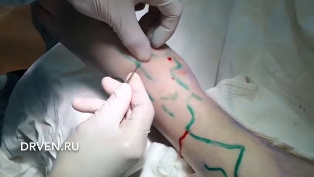 Минифлебэктомия
