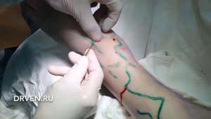 Минифлебэктомия