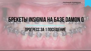 Прогресс за 1 посещения в лечении перекрестного прикуса и скученности БЕЗ удаления