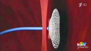 Дефект межпредсердной перегородки. Жить здорово! Фрагмент выпуска от 14.12.2016