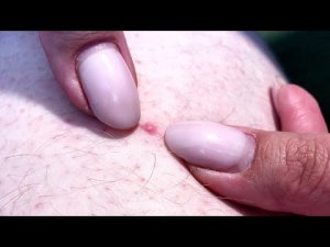 Воспалительный процесс и гнойные прыщи удаление, лечение и обработка.