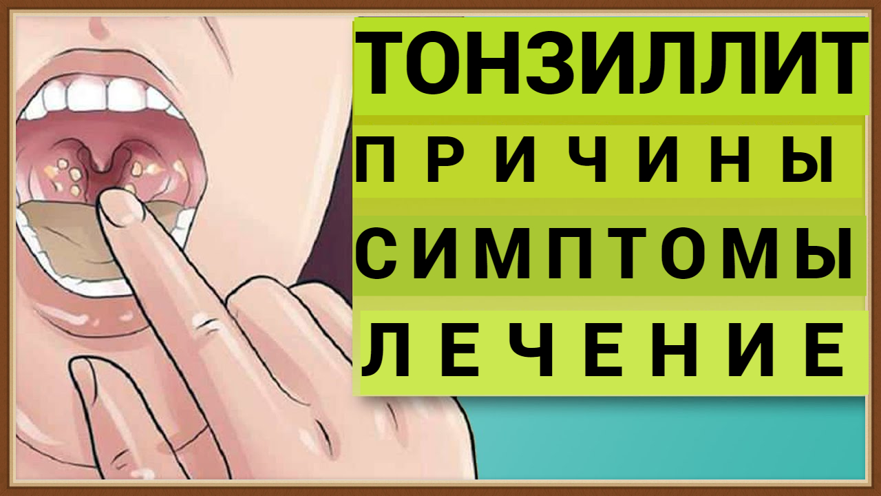 ТОНЗИЛЛИТ - ПРИЧИНЫ СИМПТОМЫ ЛЕЧЕНИЕ