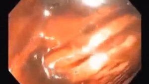 Колоноскопия Кишечника Видео Очищение Организма Фортрансом от токсинов,глистов,домашнее лечение кан