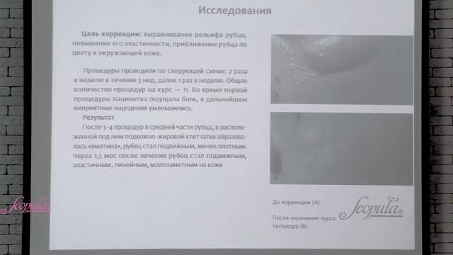 Исследование о Воздействии курса Миостимуляция + RF - лифтинг на рубцы смотреть онлайн