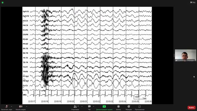 Нормальна і патологічна ЕЕГ активність людини 2022 10 26 14 30 55 смотреть онлайн