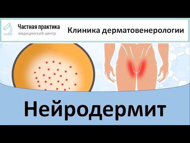 Нейродермит смотреть онлайн