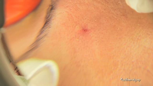 Skin Prepped & Deep Scarring Peel смотреть онлайн