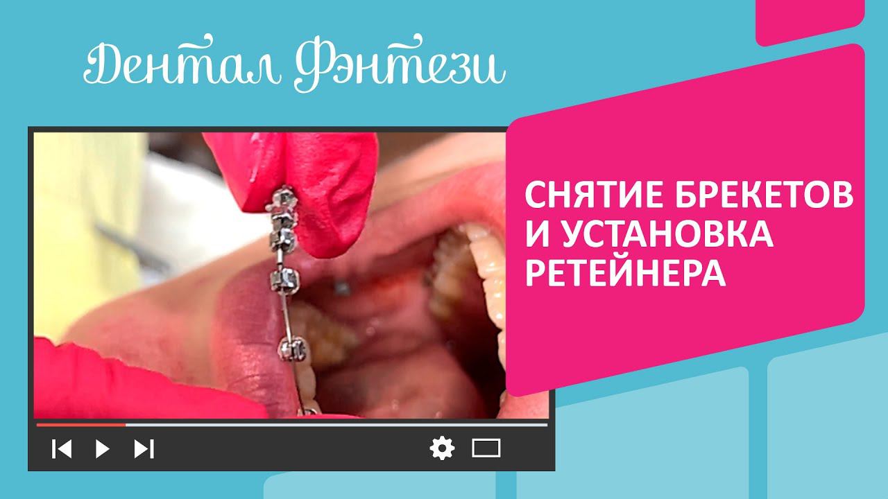 Снятие брекетов и установка ретейнера. Ортодонтическое лечение на брекетах