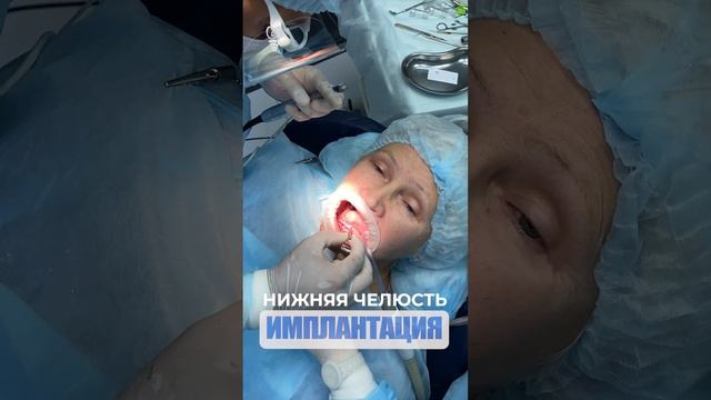 Нижняя челюсть. Lower jaw. Implantation.