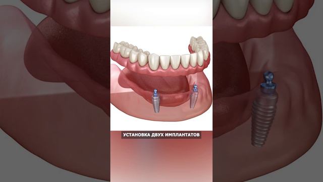 Имплантация зубов - ИДЕАЛЬНОЕ восстановление утраченных зубов #стоматология #зубы #лечение