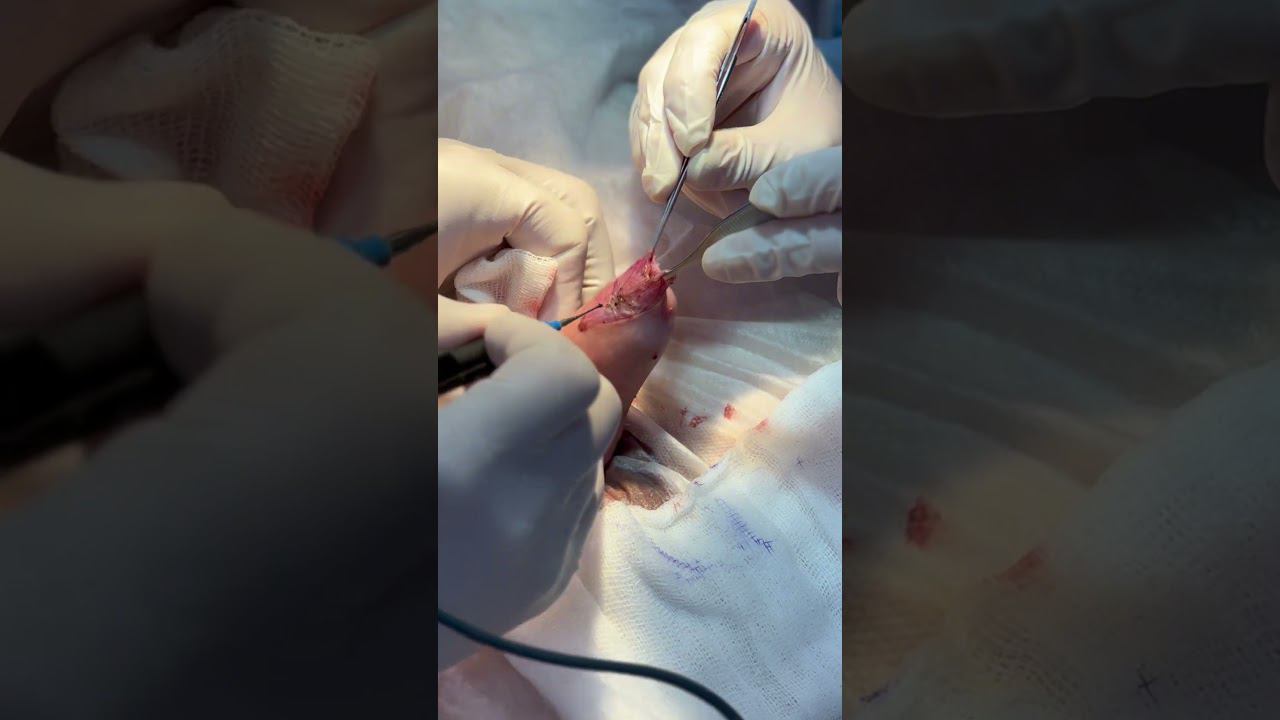 УРОЛОГИЯ.ОБРЕЗАНИЕ БЕЗ ОЖОГОВ радиоволновым скальпелем (ЦИРКУМЦИЗИЯ)#circumcision #обрезание #shorts