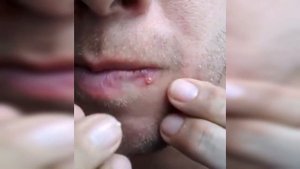подборка выдавливания прыщей шорт 1 II выдавливание прыщей