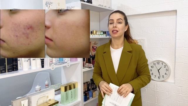 Миндальный пилинг самый мягкий смотреть онлайн