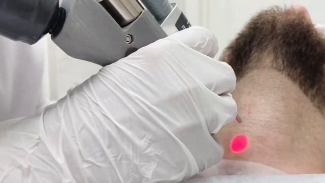 Лазерная эпиляция для мужчин смотреть онлайн