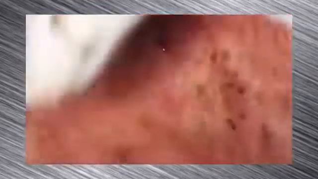 Чистка кожи смотреть онлайн