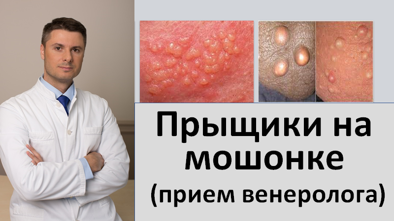 Прыщики на мошонке. Прием венеролога