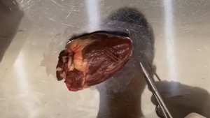 Ушивание ран сердца
