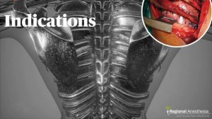 Межреберная блокада под УЗ-навигацией