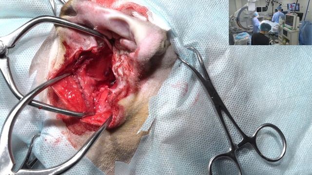 Удаление слухового хода и буллы. смотреть онлайн