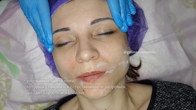 Микроигольчатая Мезотерапия с использованием Биофиллера