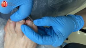 Боковой Онихолизис из-за тесной обуви / Зачем делать зачистку?