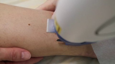 Коагуляция сосудов