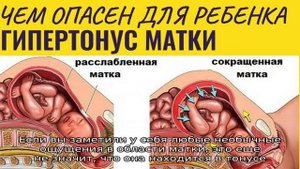 Тонус матки на раннем сроке беременности – нужно ли бояться такого диагноза?