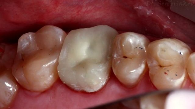 Зуб от А до Я или прощай штампачек ! смотреть онлайн