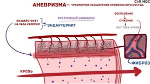 Аневризмы - виды, причины, симптомы, последствия