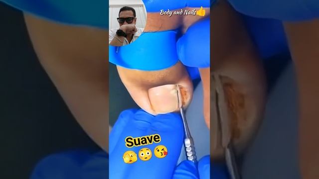 Suave ??? #relaxingvideo #ingrown_toenail #pedicure #podiatrist