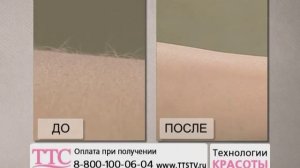 Лазерный эпилятор «Рио»